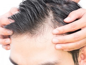 مراقبت از موهای کاشته شده بعد از کاشت مو