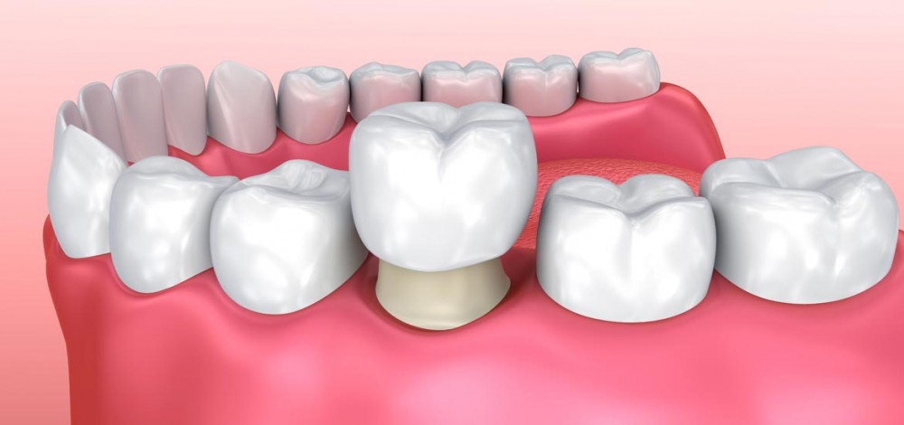 تاج گذاشتن روی دندان