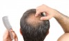 هر آنچه باید در مورد کاشت مو در رشت بدانید