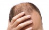 هر آنچه باید در مورد کاشت مو در سنندج بدانید