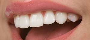 در مورد جراحی زیبایی دندان در اراک بیشتر بدانید
