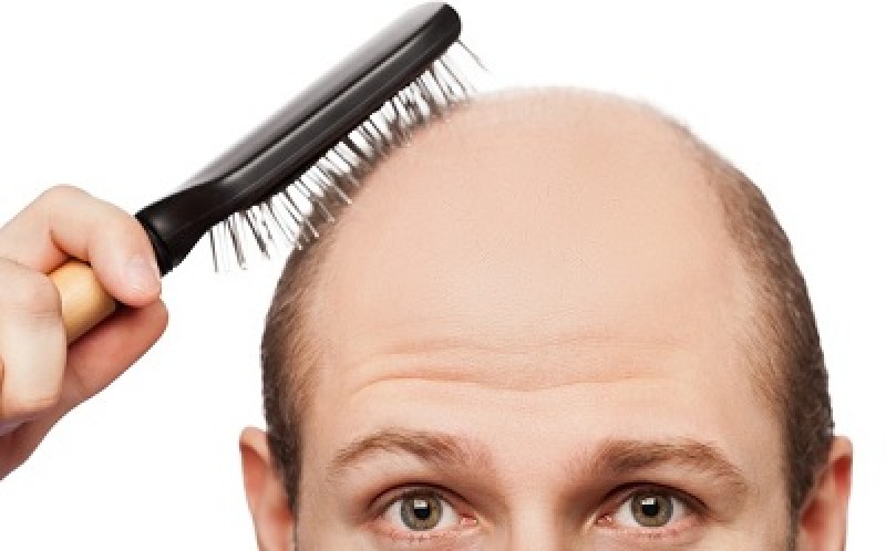 هر آنچه باید در مورد کاشت مو در بوشهر بدانید