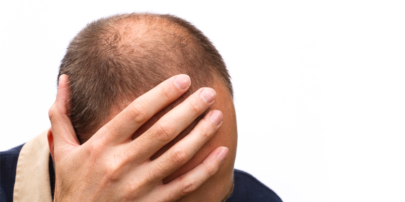 هر آنچه باید در مورد کاشت مو در قزوین بدانید