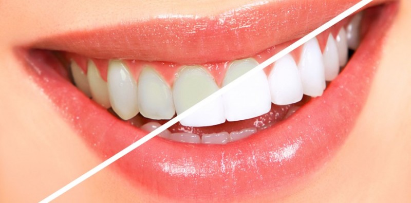 در مورد جراحی زیبایی دندان در کرمان بیشتر بدانید