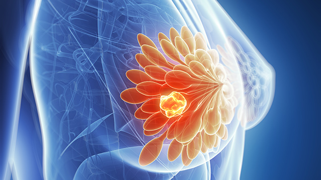 جع عواملی خطر ابتلا به سرطان سینه را افزایش می دهند